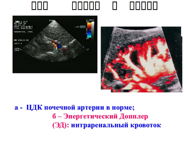 а -  ЦДК почечной артерии в норме;   б – Энергетический Допплер